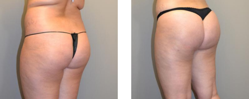 Lipofilling des fesses Tunisie