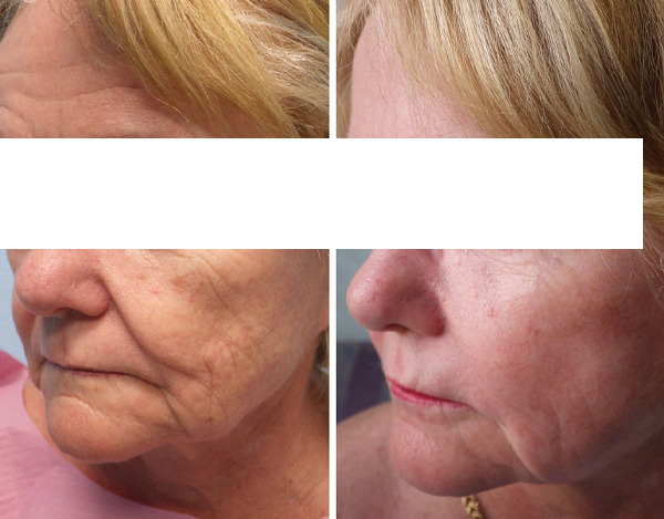 Lipofilling visage Tunisie