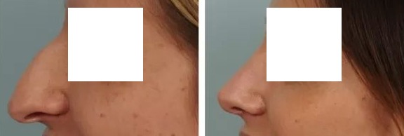 Rhinoplastie Tunisie