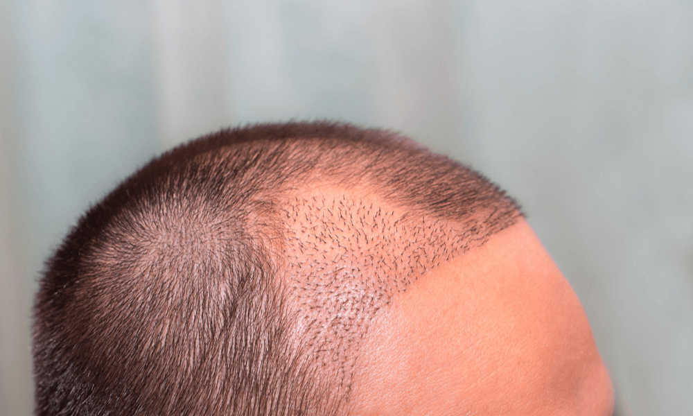Greffe de cheveux pour Africains